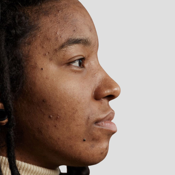 Oily, breakout prone