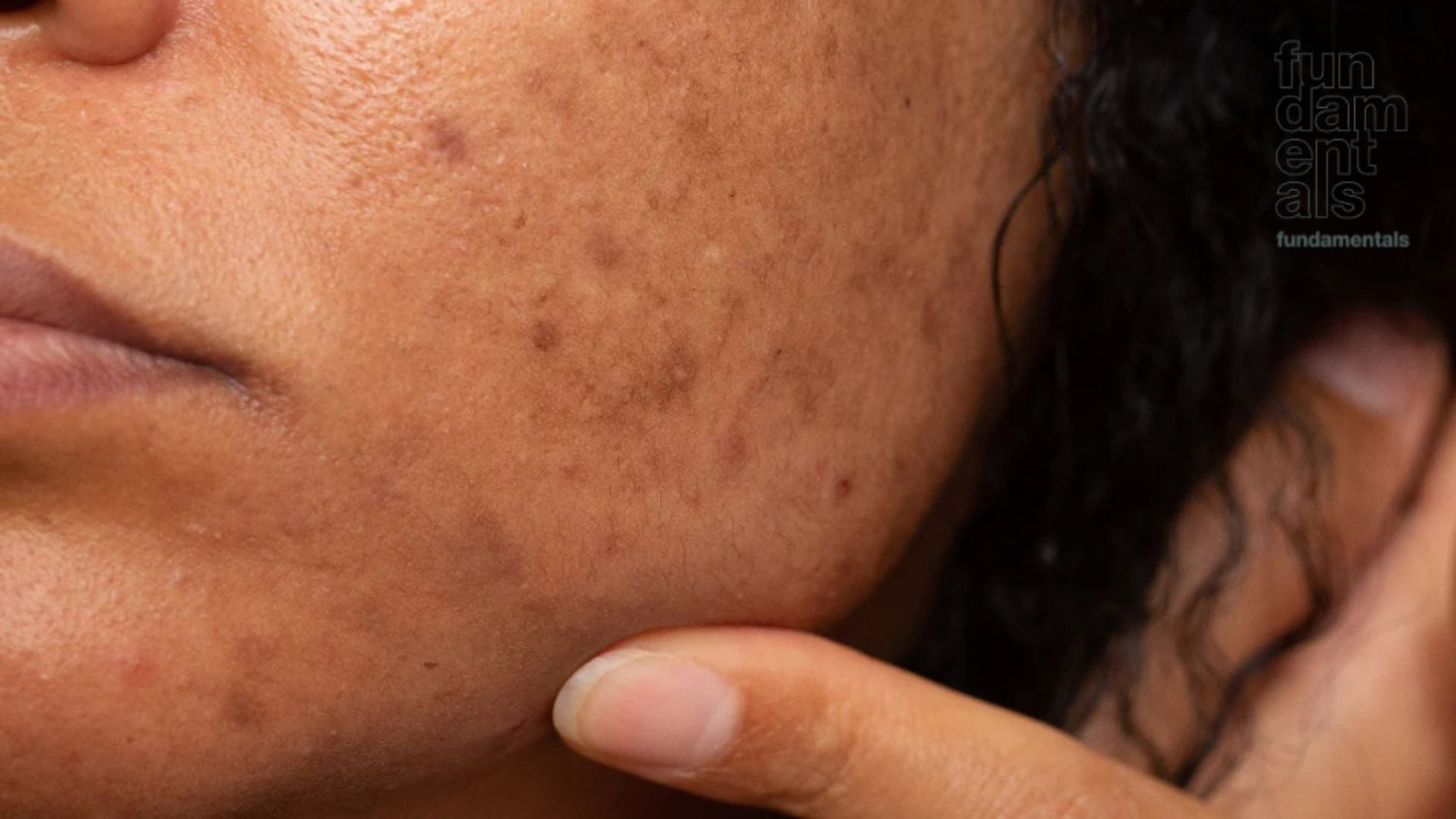 Addressing skin pigmentation in South Africa : Fundamentals Skincare launches “Pigmentation warrior serum”